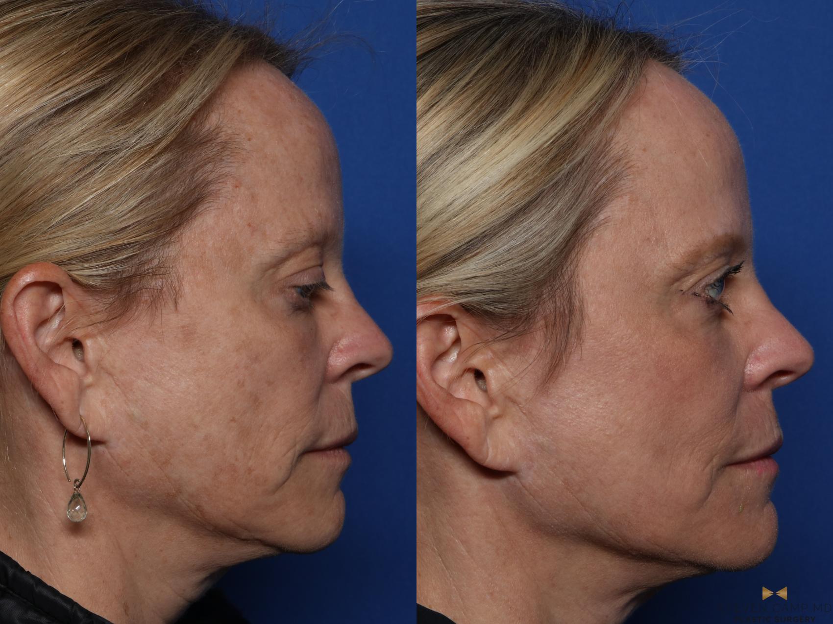 Before & After Sciton Laser Case 522 Right Side View in Fort Worth & Arlington, Texas