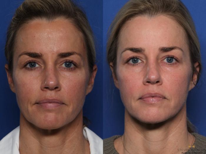 Before & After BOTOX Case 525 Front View in Fort Worth & Arlington, Texas