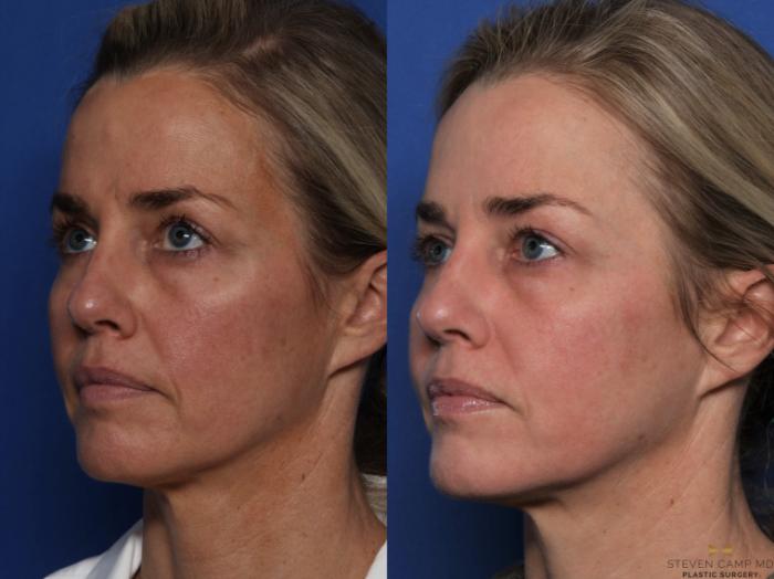 Before & After BOTOX Case 525 Left Oblique View in Fort Worth & Arlington, Texas