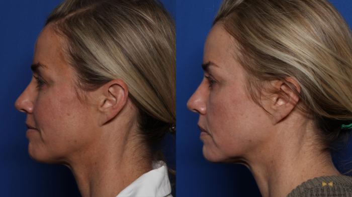Before & After BOTOX Case 525 Left Side View in Fort Worth & Arlington, Texas