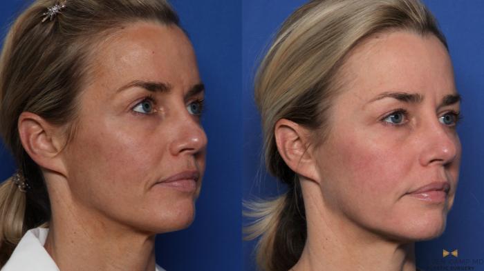 Before & After BOTOX Case 525 Right Oblique View in Fort Worth & Arlington, Texas