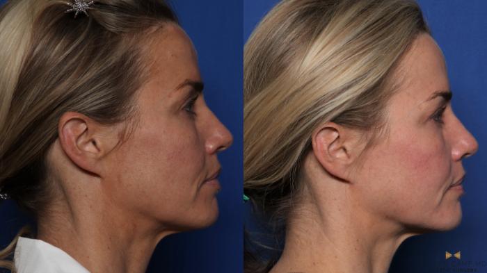 Before & After Sciton Laser Case 525 Right Side View in Fort Worth, Texas
