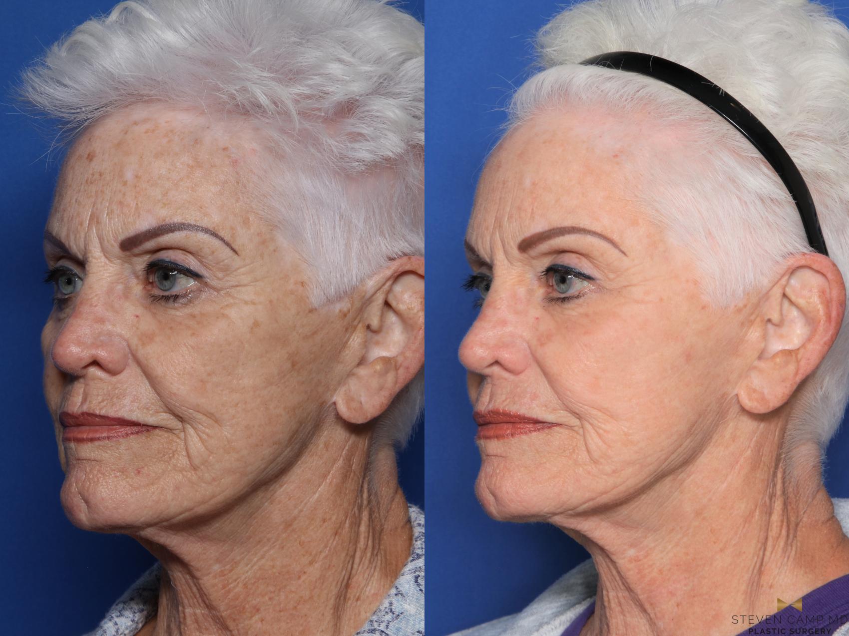 Before & After Sciton Laser Case 531 Left Oblique View in Fort Worth, Texas