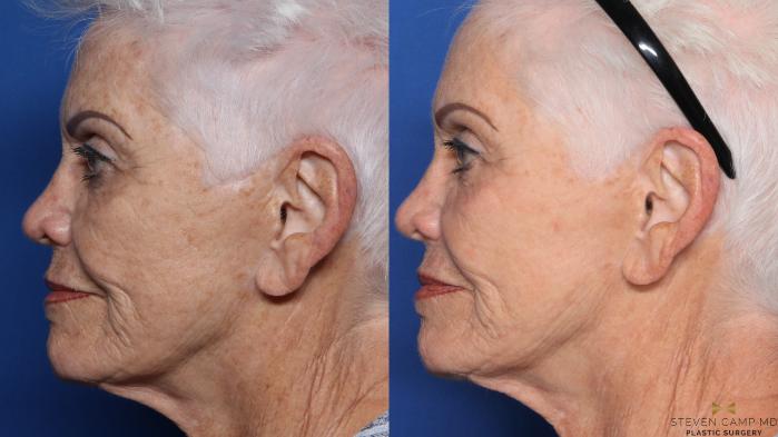 Before & After Sciton Laser Case 531 Left Side View in Fort Worth, Texas