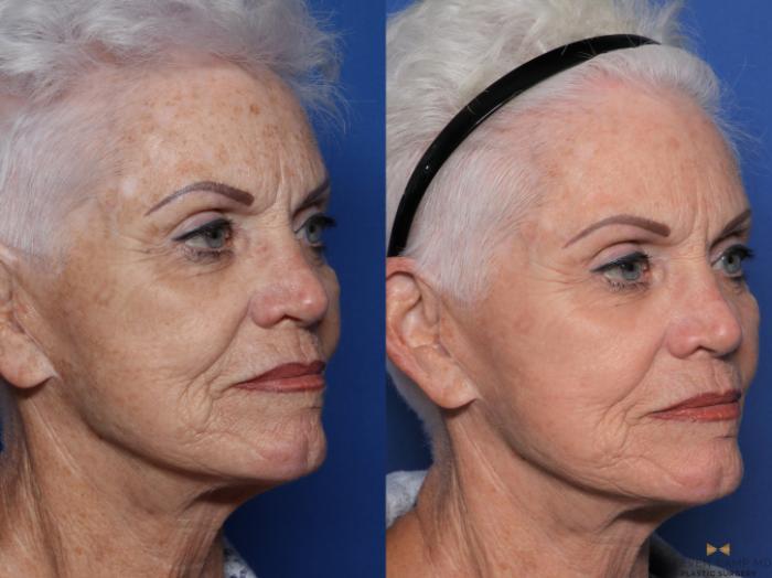 Before & After Sciton Laser Case 531 Right Oblique View in Fort Worth, Texas