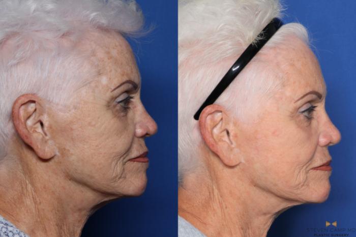 Before & After Sciton Laser Case 531 Right Side View in Fort Worth, Texas