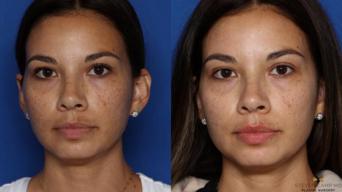 Before & After Sciton Laser Case 535 Front View in Fort Worth & Arlington, Texas