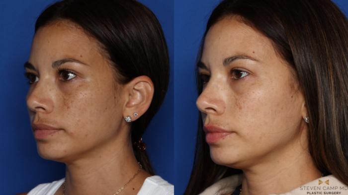 Before & After Sciton Laser Case 535 Left Oblique View in Fort Worth & Arlington, Texas