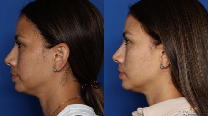 Before & After Sciton Laser Case 535 Left Side View in Fort Worth & Arlington, Texas