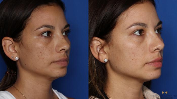 Before & After Sciton Laser Case 535 Right Oblique View in Fort Worth & Arlington, Texas