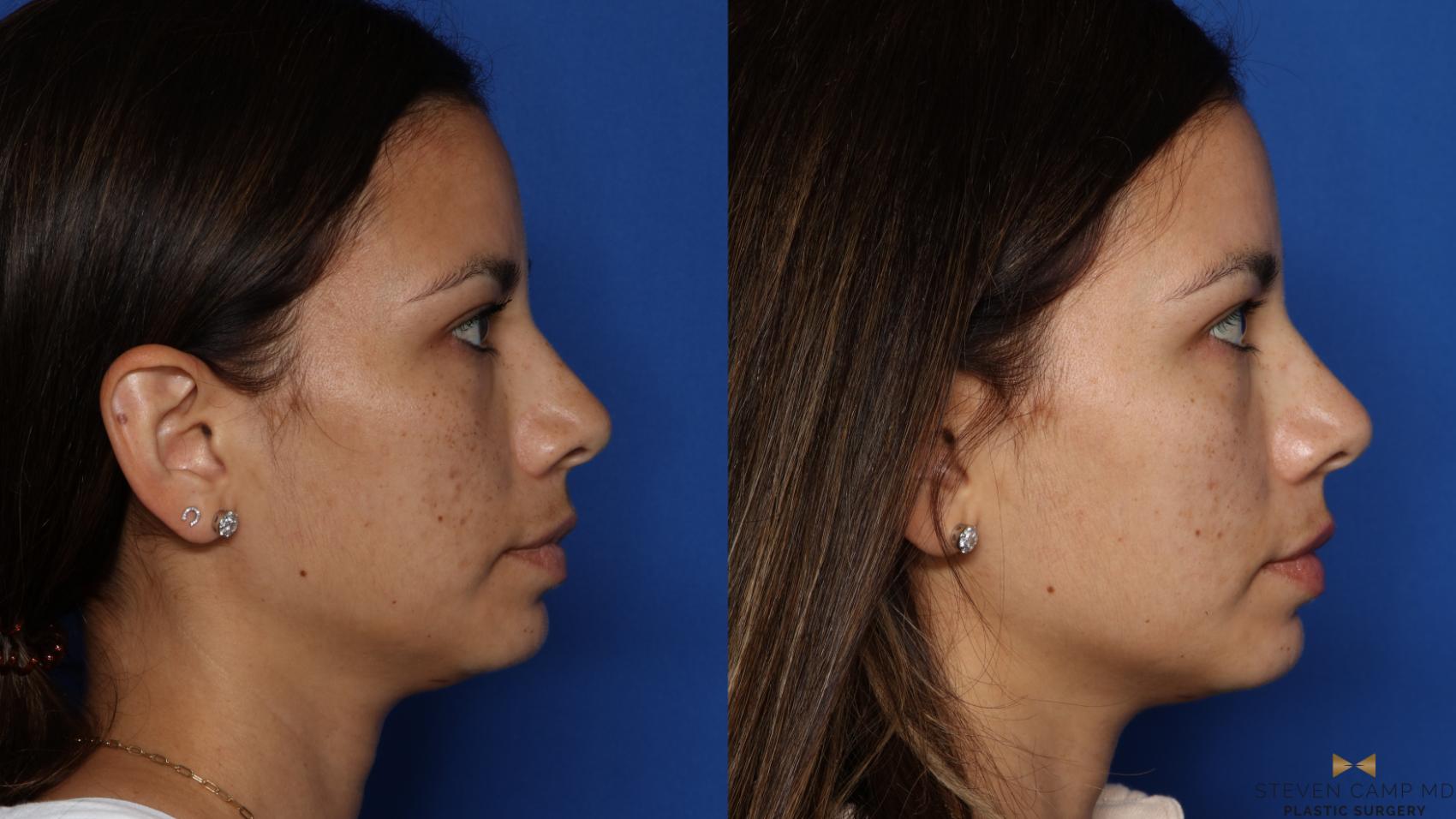 Before & After Sciton Laser Case 535 Right Side View in Fort Worth & Arlington, Texas