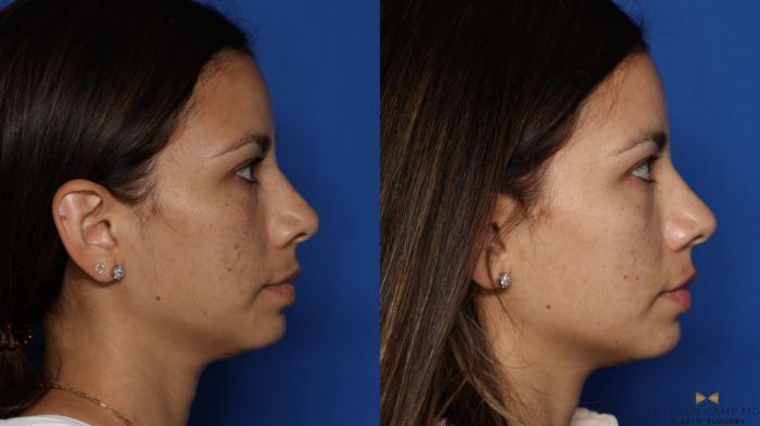 Before & After Sciton Laser Case 535 Right Side View in Fort Worth & Arlington, Texas