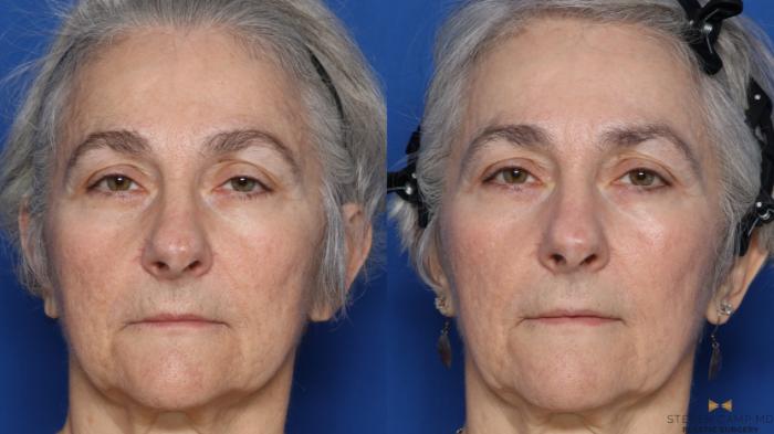 Before & After Sciton Laser Case 564 Front View in Fort Worth & Arlington, Texas