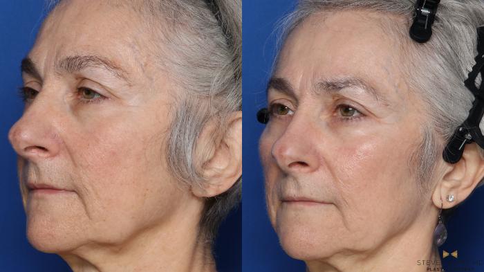 Before & After Sciton Laser Case 564 Left Oblique View in Fort Worth & Arlington, Texas