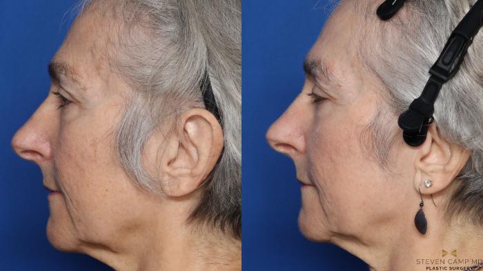 Before & After Sciton Laser Case 564 Left Side View in Fort Worth & Arlington, Texas