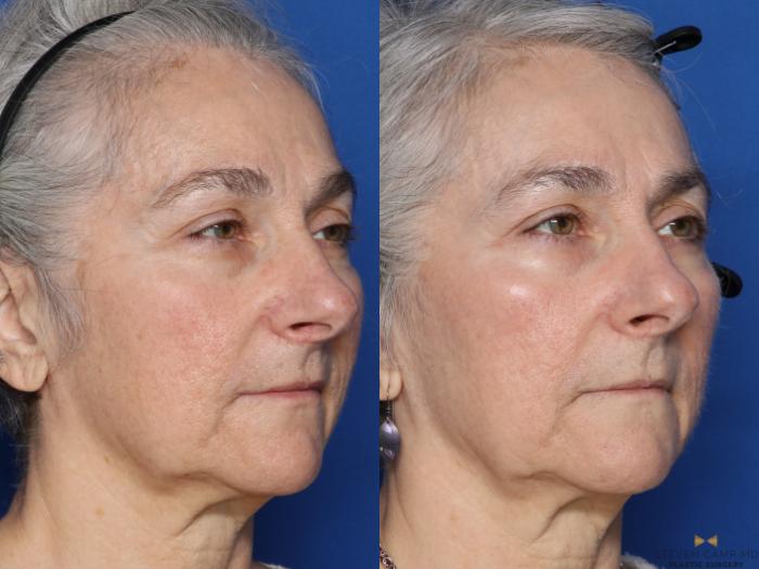 Before & After Sciton Laser Case 564 Right Oblique View in Fort Worth & Arlington, Texas