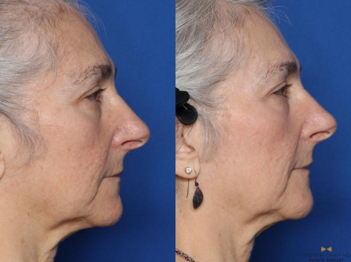 Before & After Sciton Laser Case 564 Right Side View in Fort Worth & Arlington, Texas