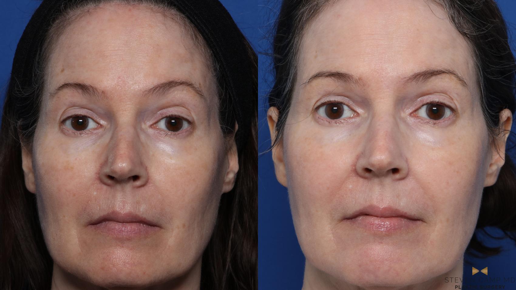 Before & After Sciton Laser Case 580 Front View in Fort Worth, Texas