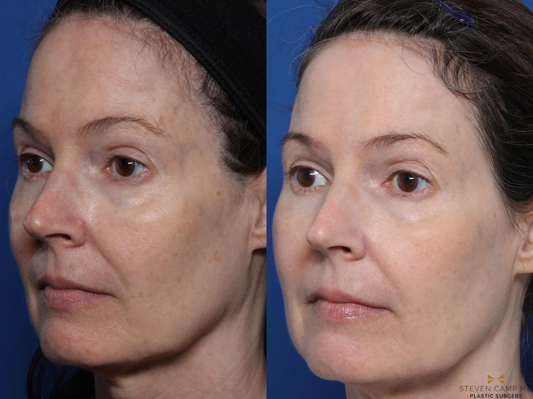 Before & After Sciton Laser Case 580 Left Oblique View in Fort Worth & Arlington, Texas