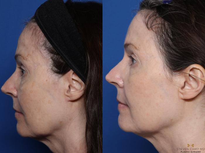 Before & After Sciton Laser Case 580 Left Side View in Fort Worth, Texas