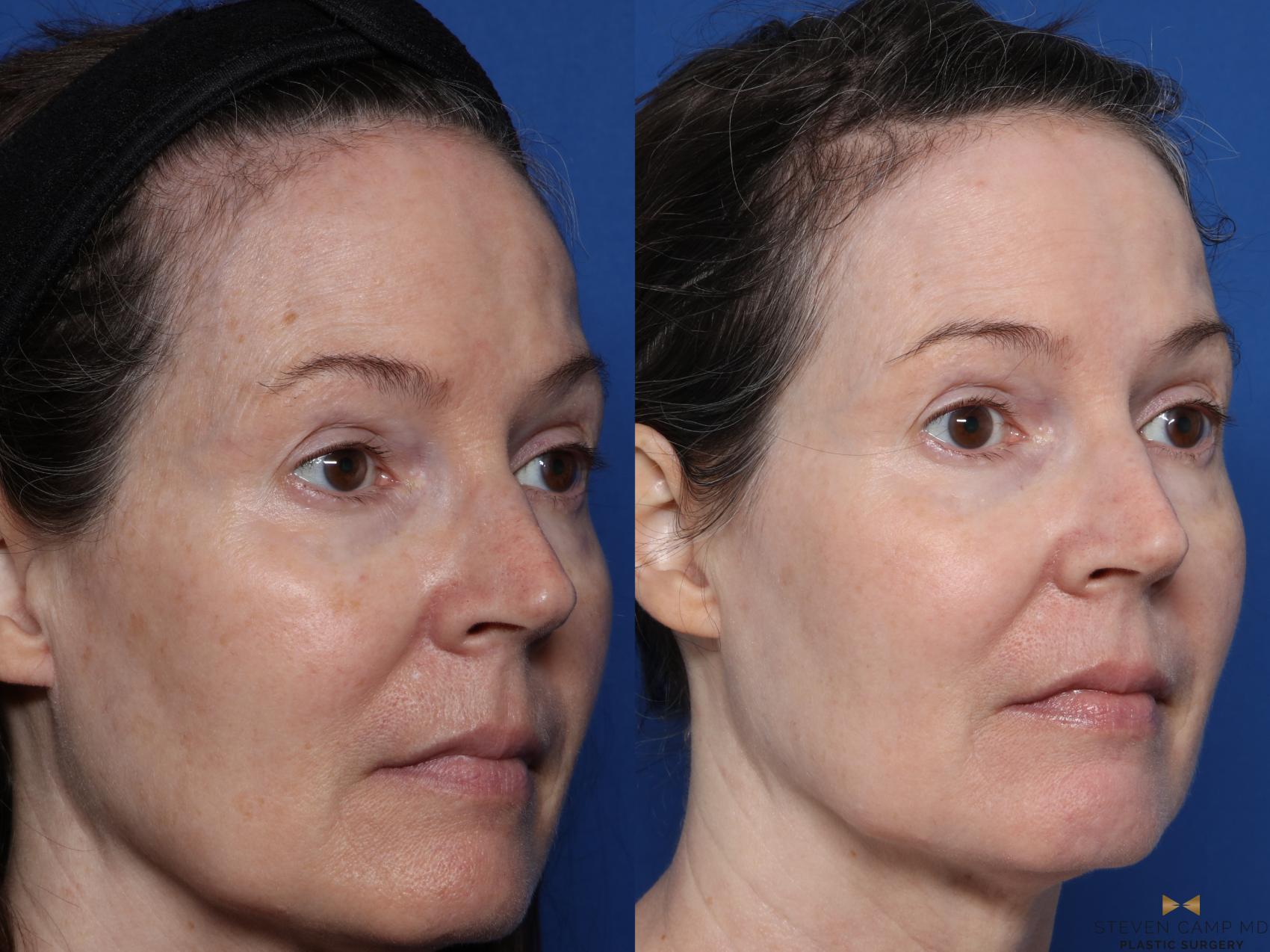 Before & After Sciton Laser Case 580 Right Oblique View in Fort Worth & Arlington, Texas