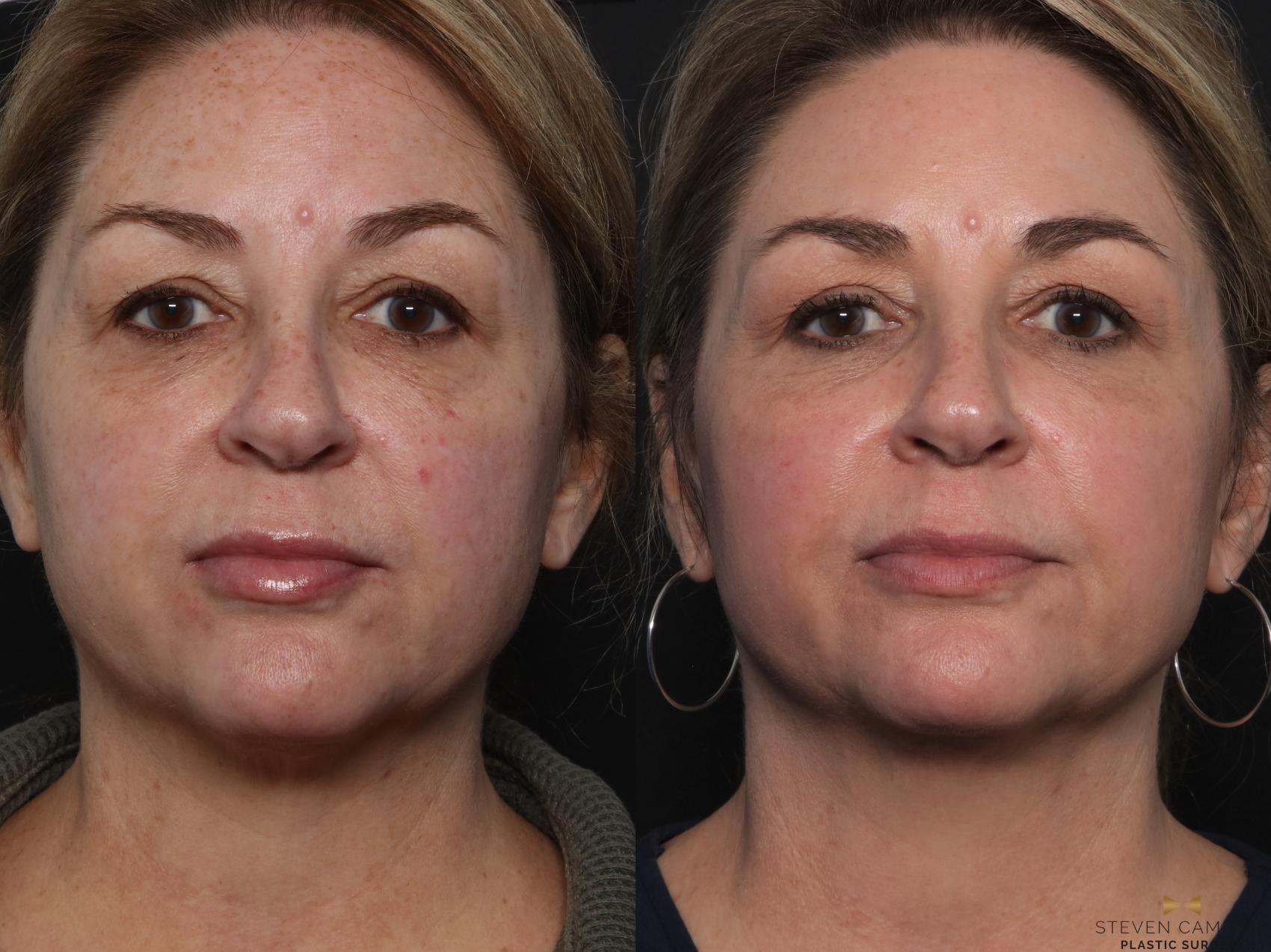Before & After Sciton Laser Case 598 Front View in Fort Worth & Arlington, Texas