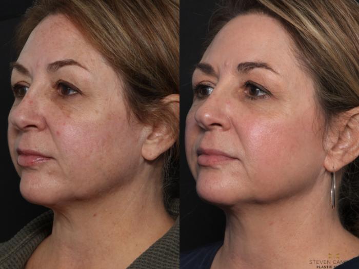 Before & After Sciton Laser Case 598 Left Oblique View in Fort Worth & Arlington, Texas