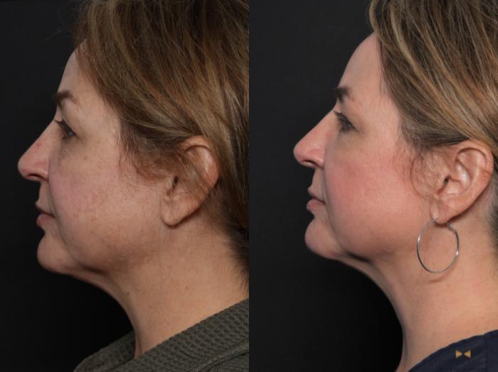 Before & After Sciton Laser Case 598 Left Side View in Fort Worth & Arlington, Texas
