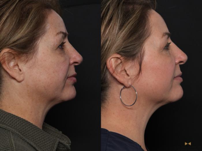 Before & After Sciton Laser Case 598 Right Side View in Fort Worth & Arlington, Texas