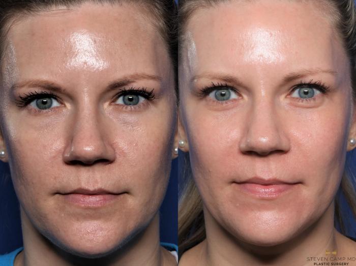 Before & After Sciton Laser Case 602 Front View in Fort Worth & Arlington, Texas