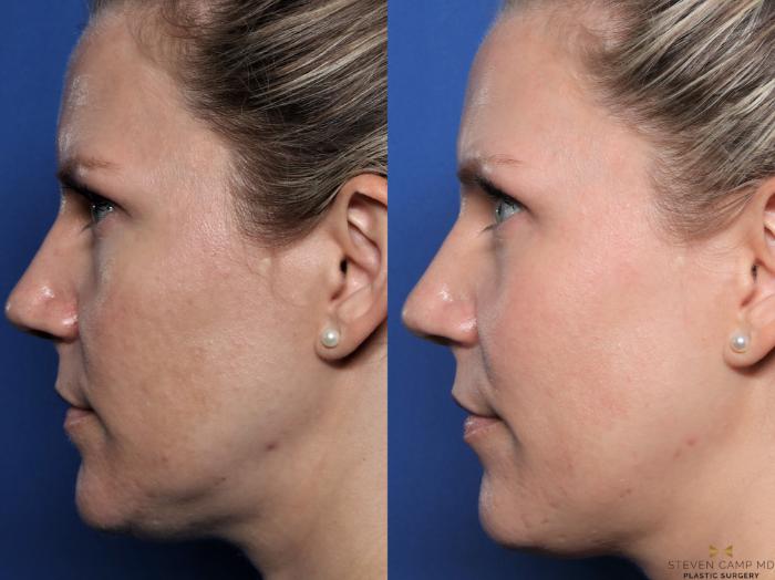 Before & After Sciton Laser Case 602 Left Side View in Fort Worth & Arlington, Texas