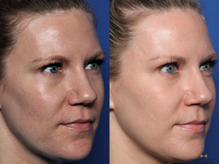 Before & After Sciton Laser Case 602 Right Oblique View in Fort Worth & Arlington, Texas