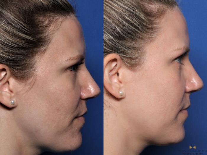 Before & After Sciton Laser Case 602 Right Side View in Fort Worth & Arlington, Texas
