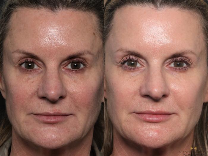 Before & After Sciton Laser Case 604 Front View in Fort Worth & Arlington, Texas