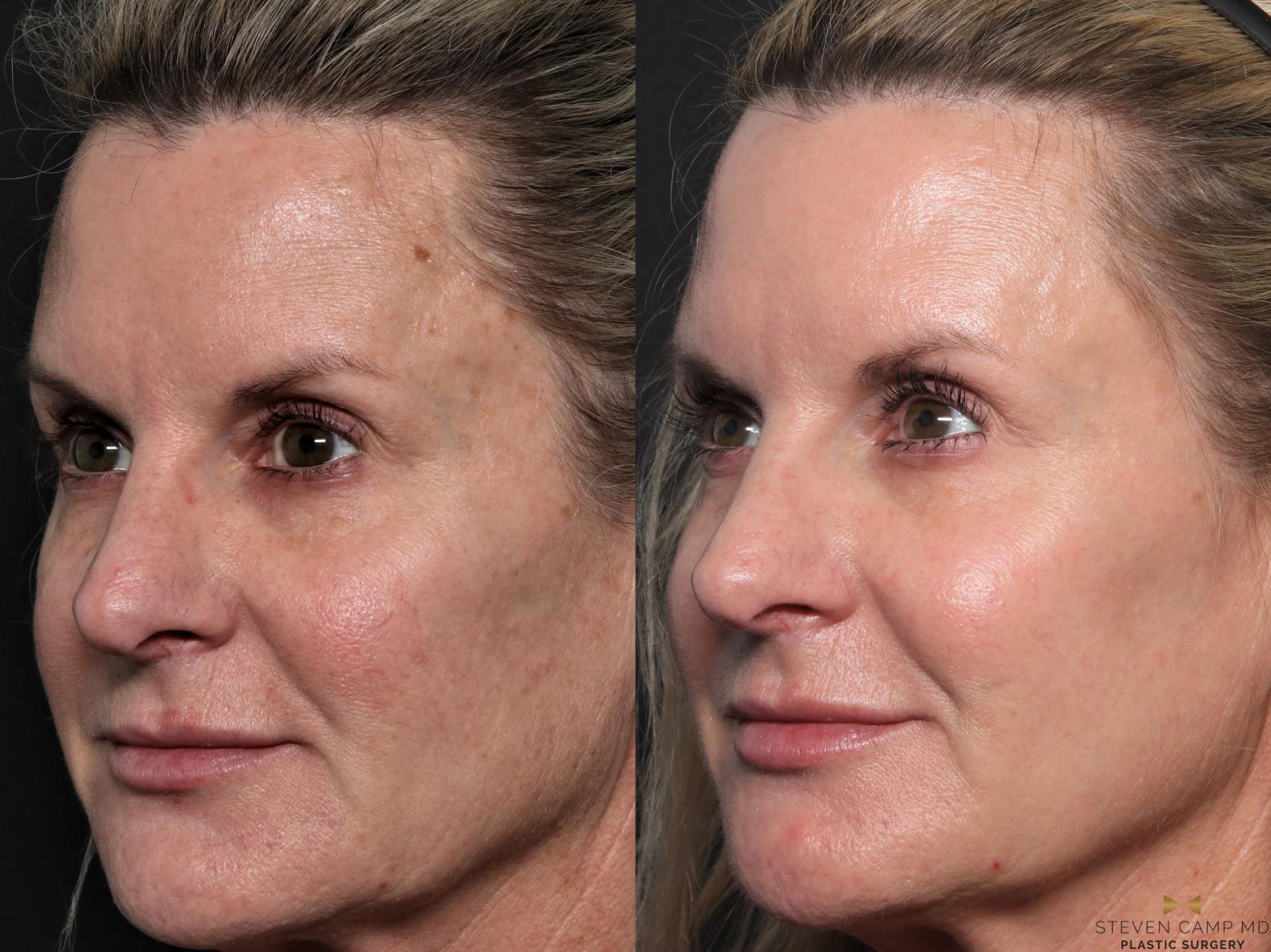 Before & After Sciton Laser Case 604 Left Oblique View in Fort Worth & Arlington, Texas