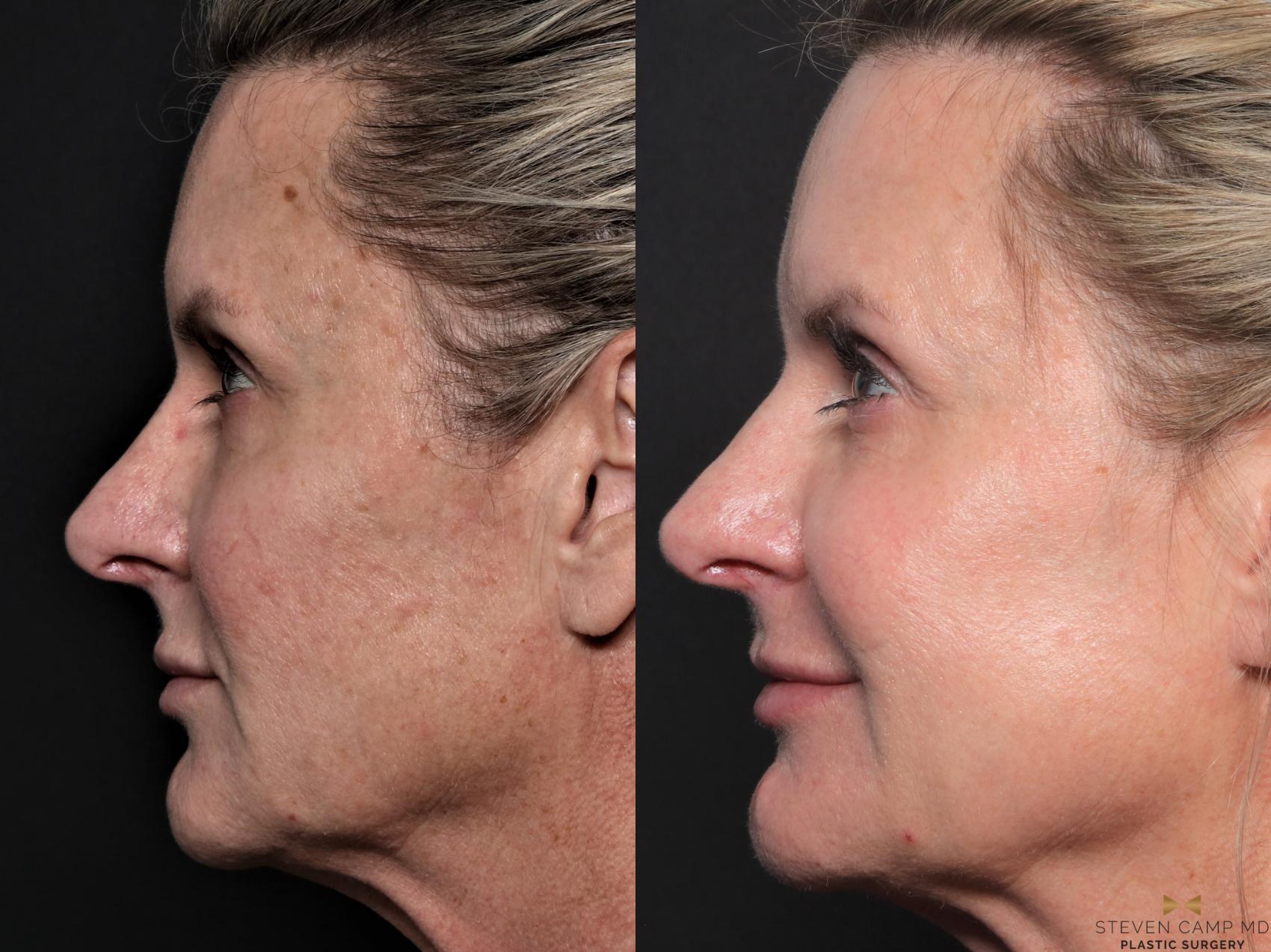 Before & After Sciton Laser Case 604 Left Side View in Fort Worth & Arlington, Texas