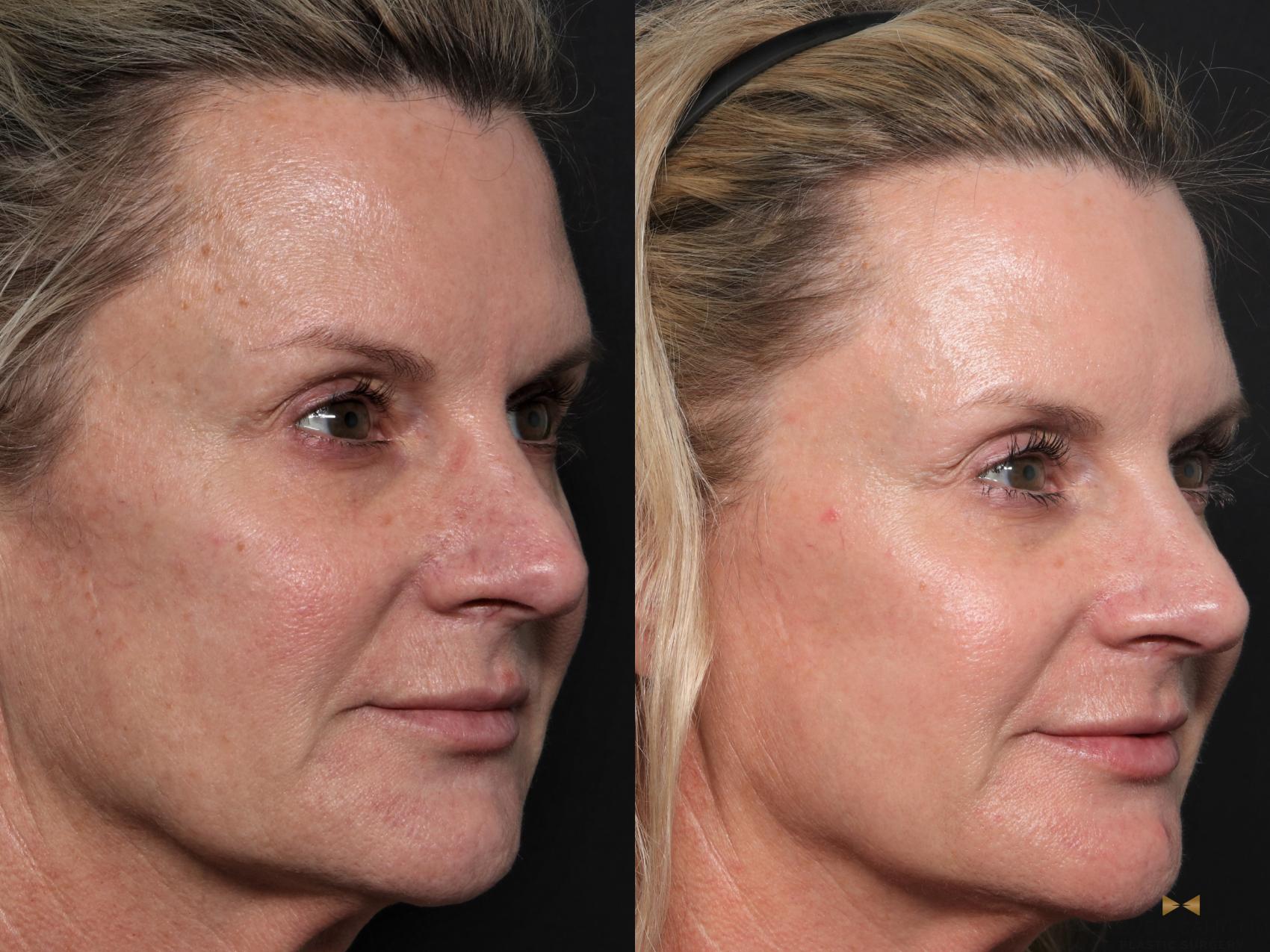 Before & After Sciton Laser Case 604 Right Oblique View in Fort Worth & Arlington, Texas