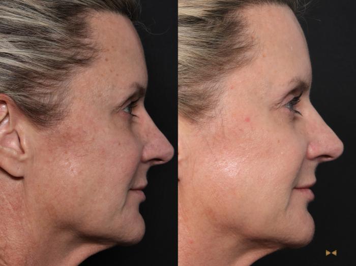 Before & After Sciton Laser Case 604 Right Side View in Fort Worth & Arlington, Texas