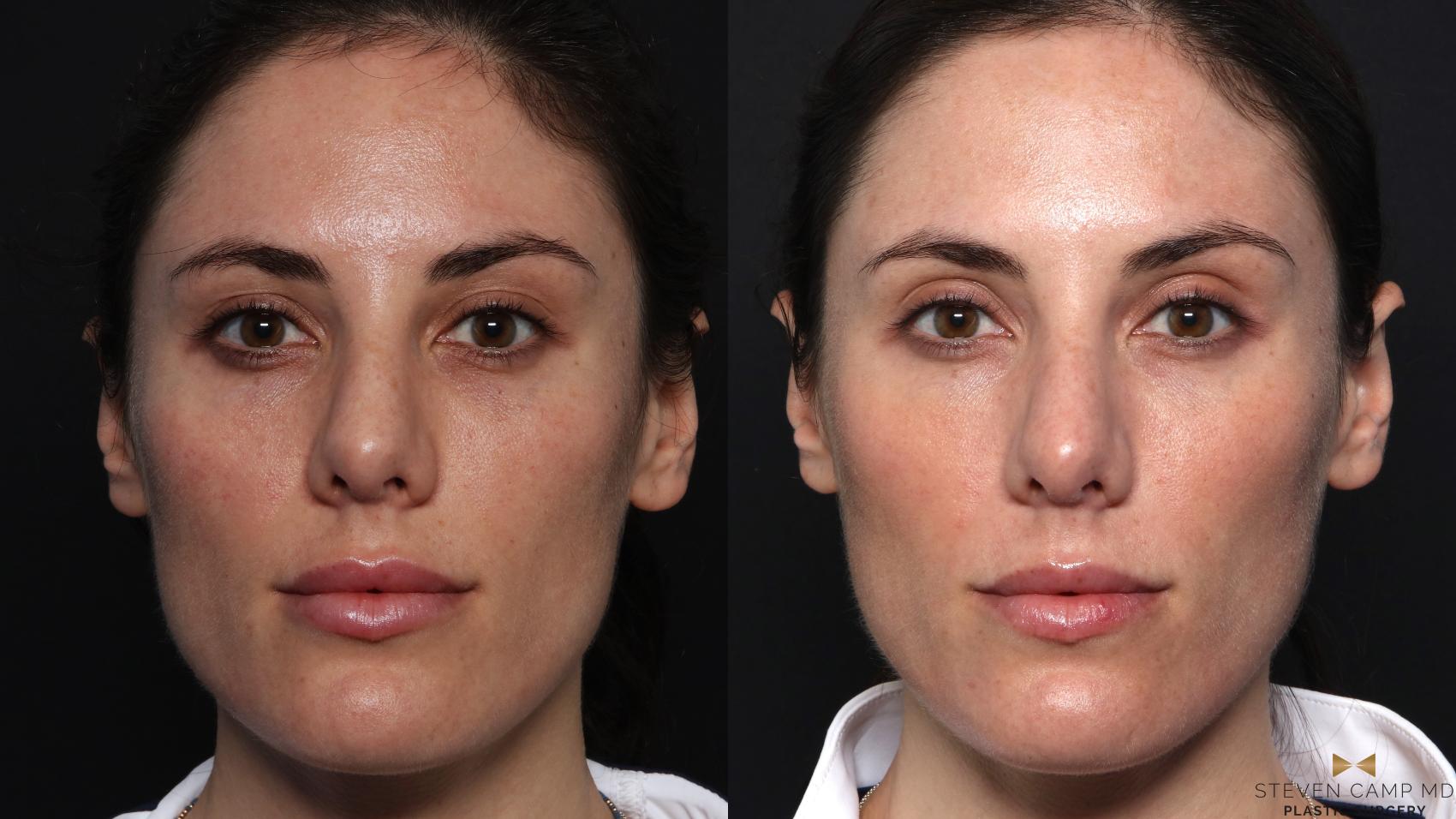 Before & After Sciton Laser Case 613 Front View in Fort Worth & Arlington, Texas