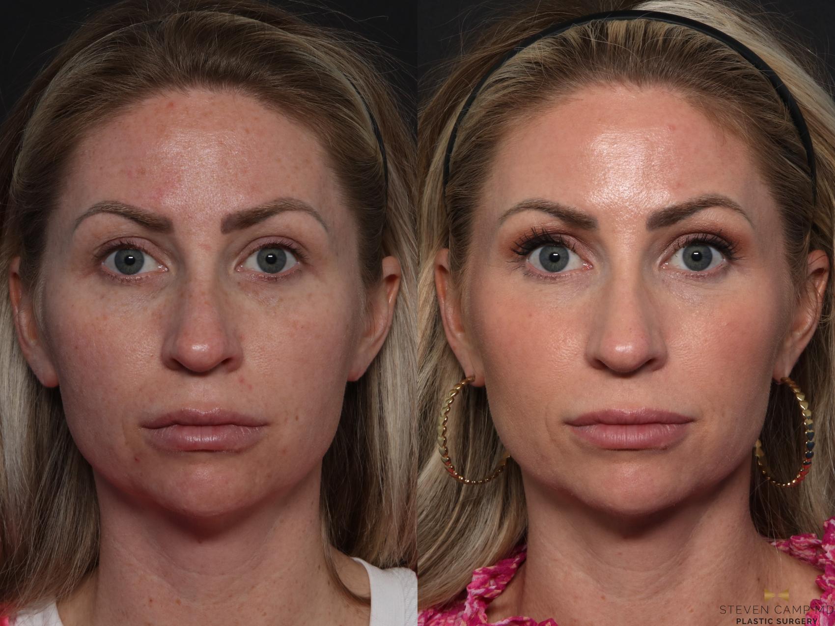 Before & After Sciton Laser Case 614 Front View in Fort Worth & Arlington, Texas