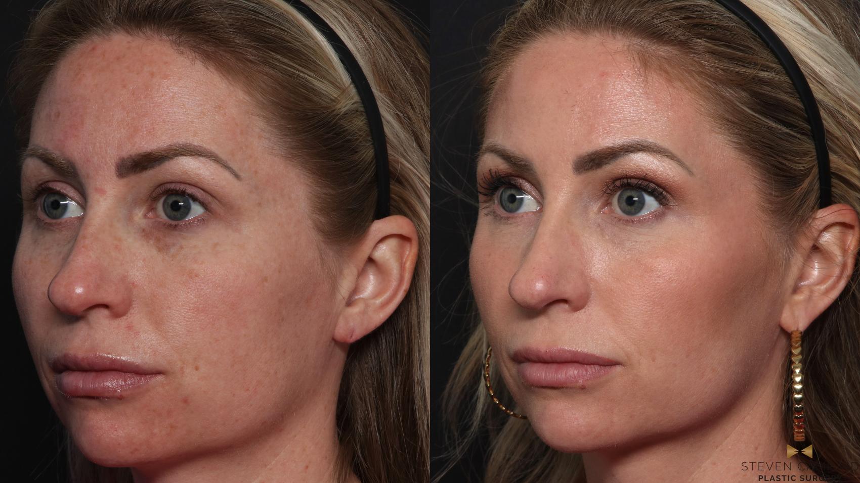 Before & After Sciton Laser Case 614 Left Oblique View in Fort Worth & Arlington, Texas