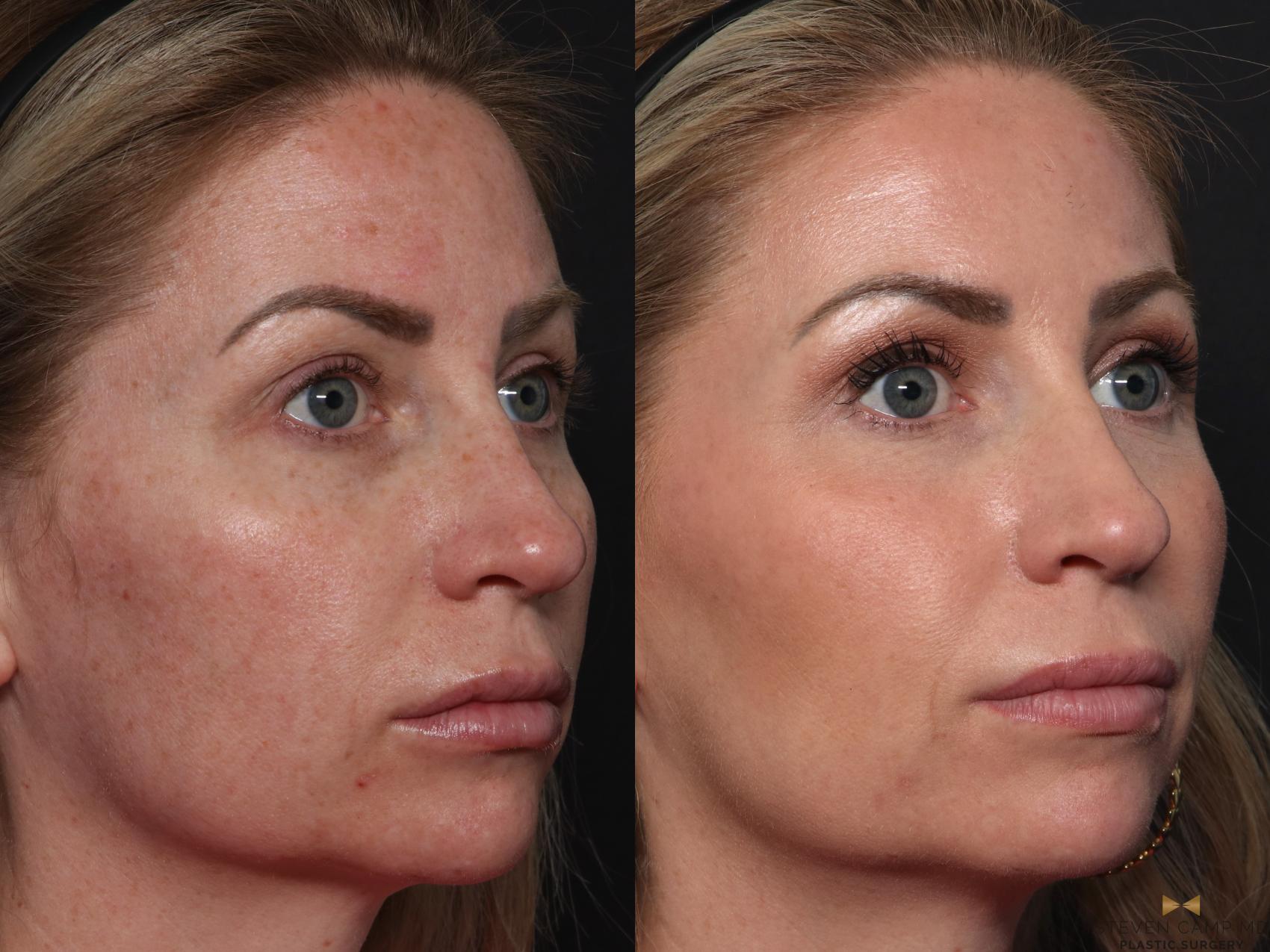 Before & After Sciton Laser Case 614 Right Oblique View in Fort Worth & Arlington, Texas