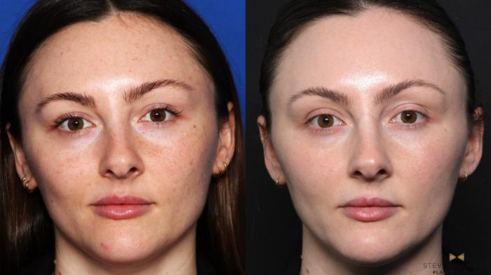 Before & After BOTOX Case 657 Front View in Fort Worth & Arlington, Texas