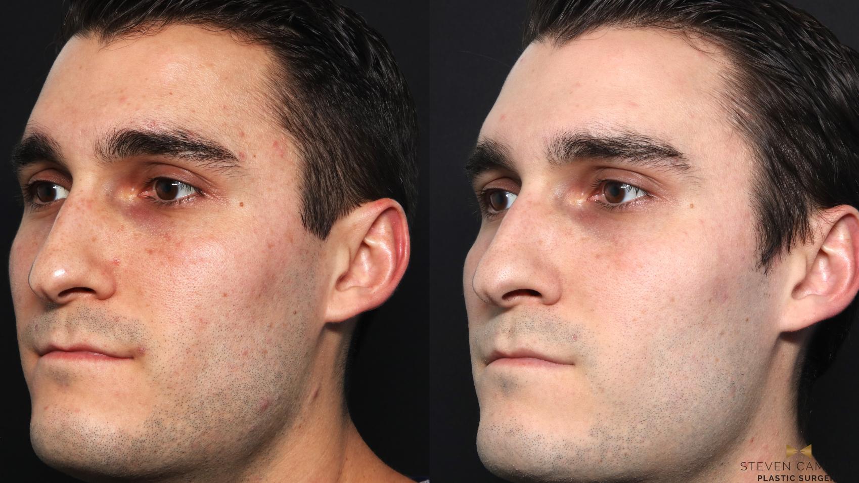 Before & After Sciton Laser Case 662 Left Oblique View in Fort Worth & Arlington, Texas