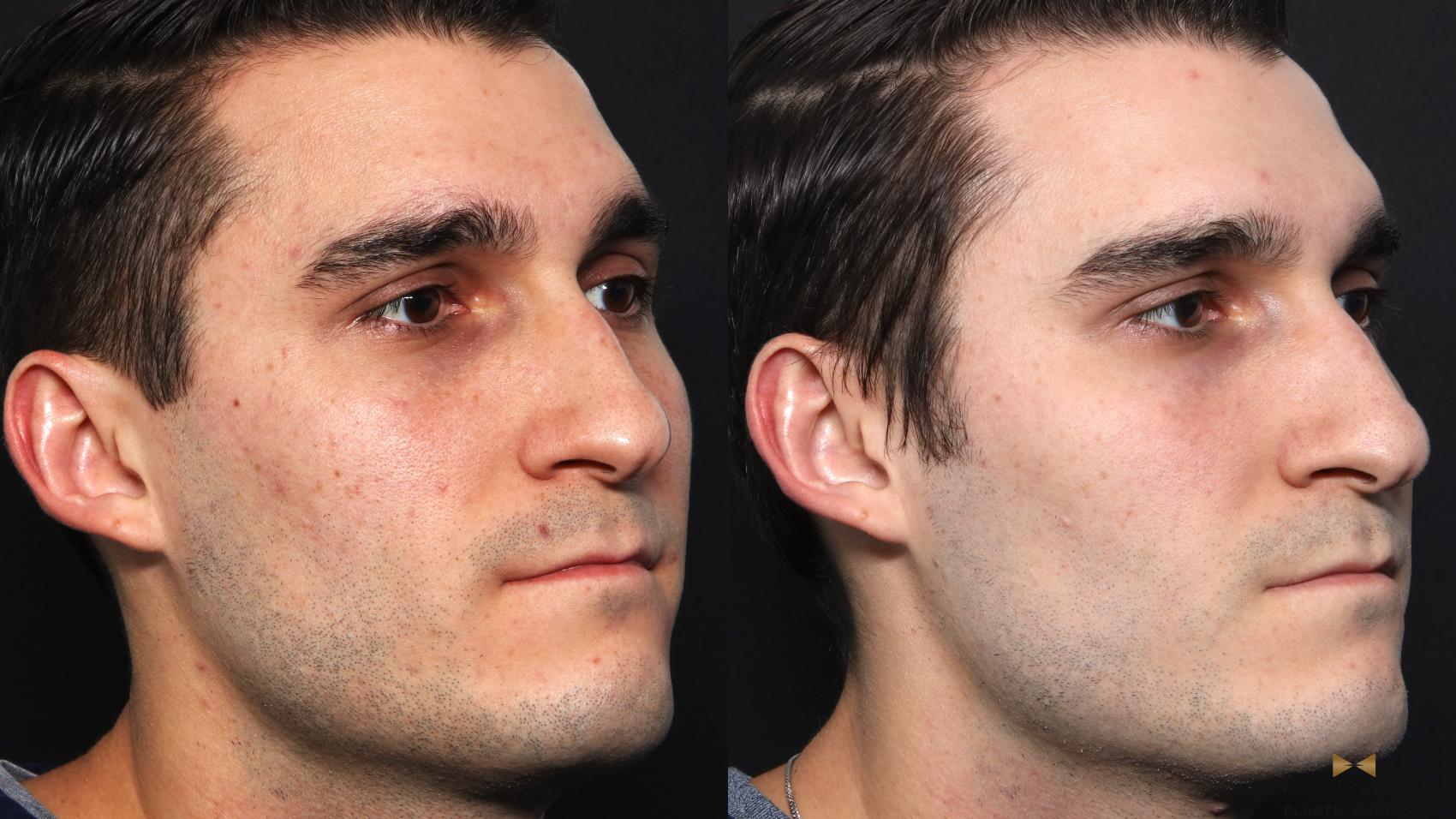 Before & After Sciton Laser Case 662 Right Oblique View in Fort Worth & Arlington, Texas