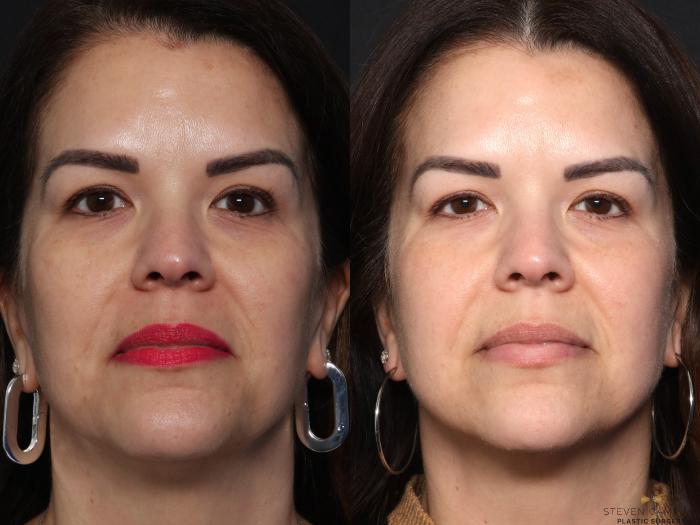 Before & After BOTOX Case 664 Front View in Fort Worth & Arlington, Texas