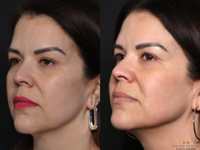 Before & After Sciton Laser Case 664 Left Oblique View in Fort Worth & Arlington, Texas
