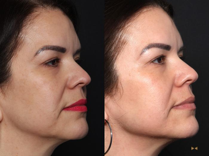 Before & After BOTOX Case 664 Right Oblique View in Fort Worth & Arlington, Texas