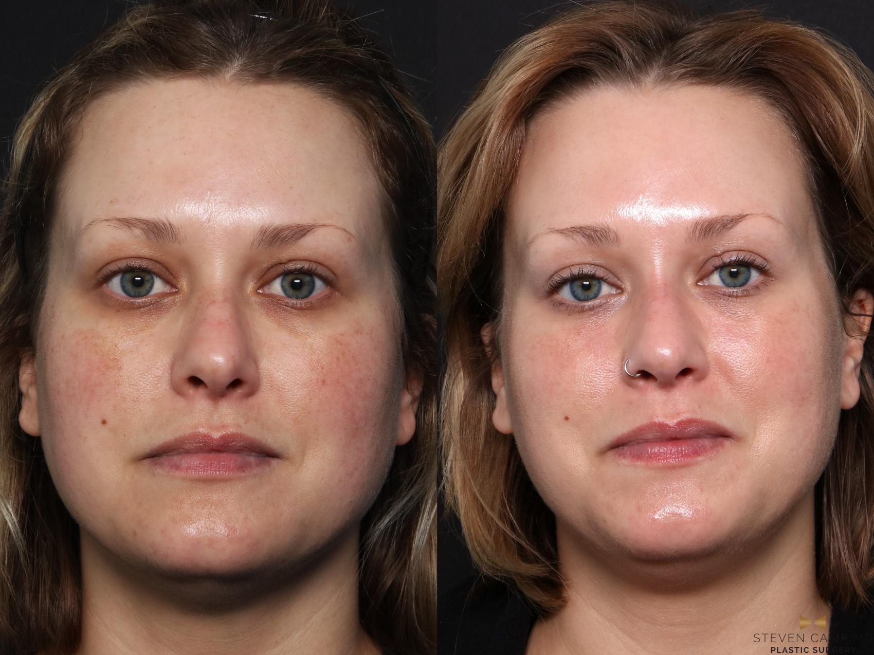 Before & After Sciton Laser Case 665 Front View in Fort Worth & Arlington, Texas