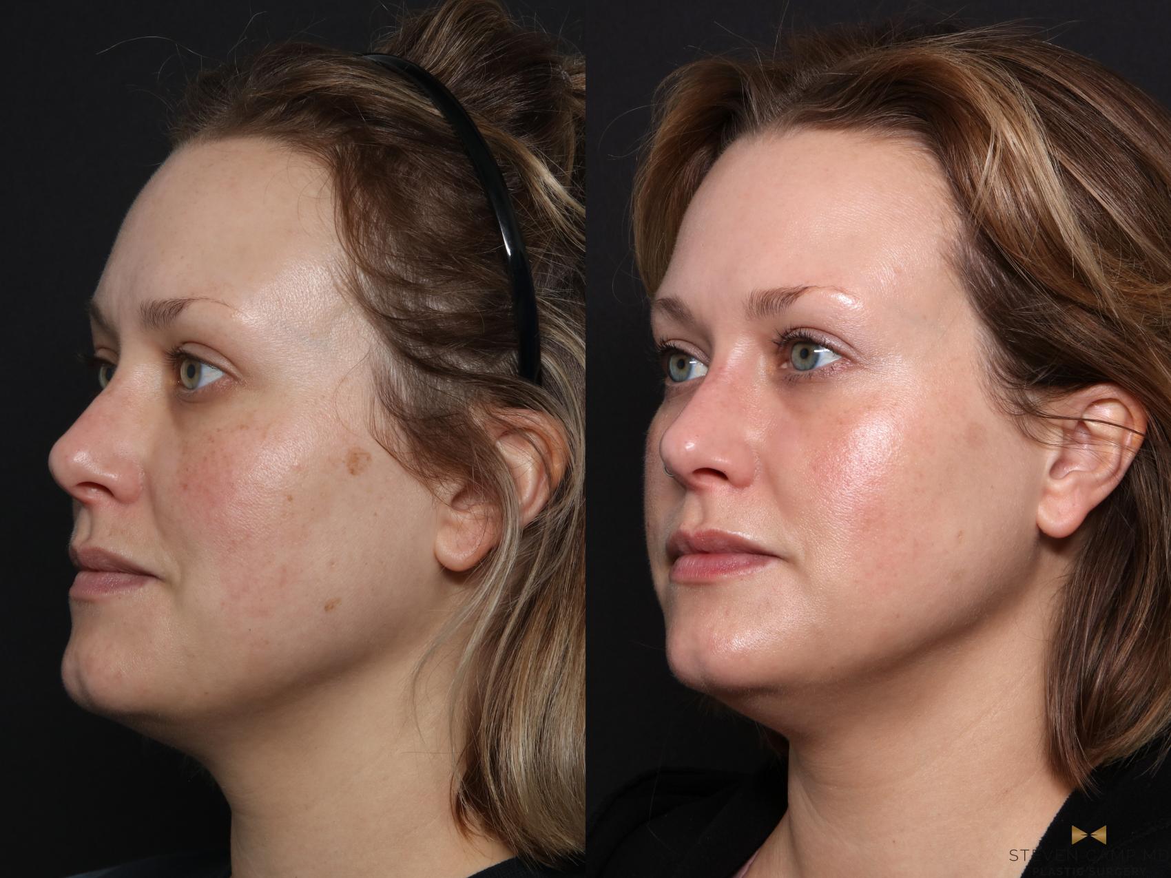 Before & After Sciton Laser Case 665 Left Oblique View in Fort Worth & Arlington, Texas